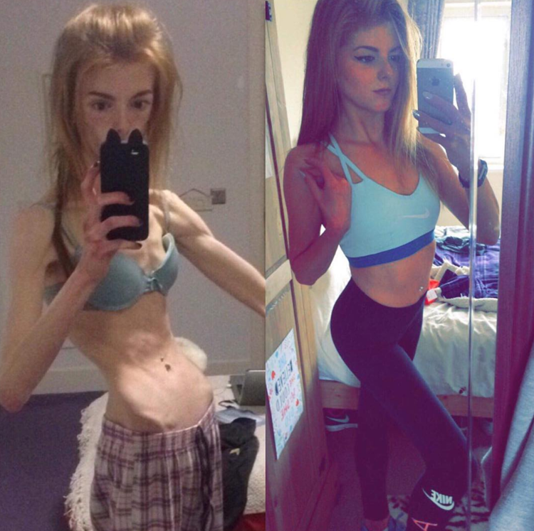 Anorexic Woman Shares Solution To Eating Disorder That Saved Her Life