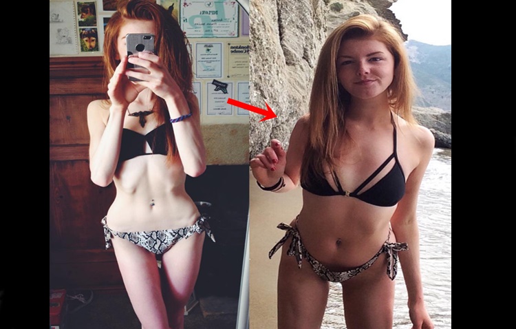 Anorexic Woman Shares Solution To Eating Disorder That Saved Her Life