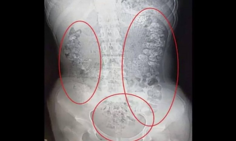 Doctors Find Undigested Bubble Tea Pearls In Girl #39 s Stomach