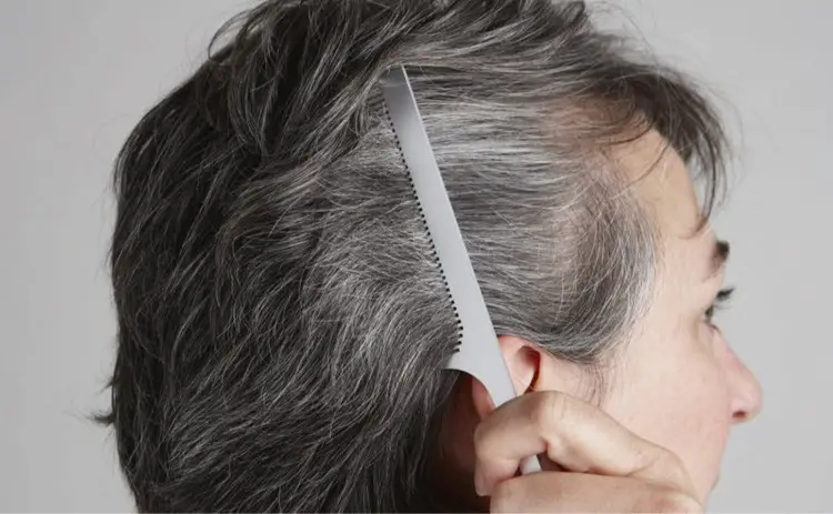 WHITE HAIR: Causes, Treatment & Tips To Prevent Premature Graying of Hair