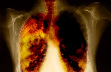 Lung Cancer