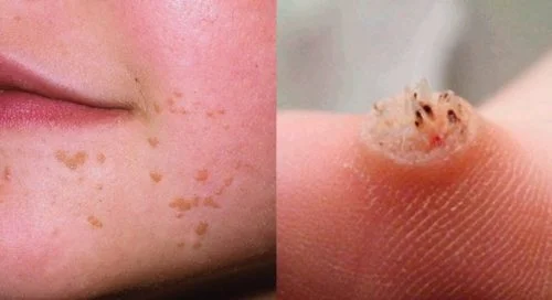 warts