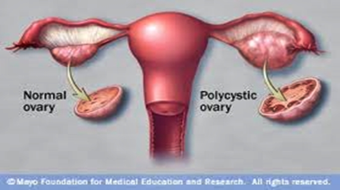 Polycystic ovary compared to a normal ovary.