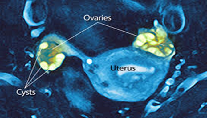 Polycystic Ovaries 2
