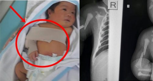 Baby's Broken Arm
