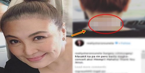 sharon cuneta surgery