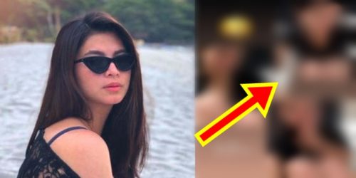 Angel Locsin bruises 2