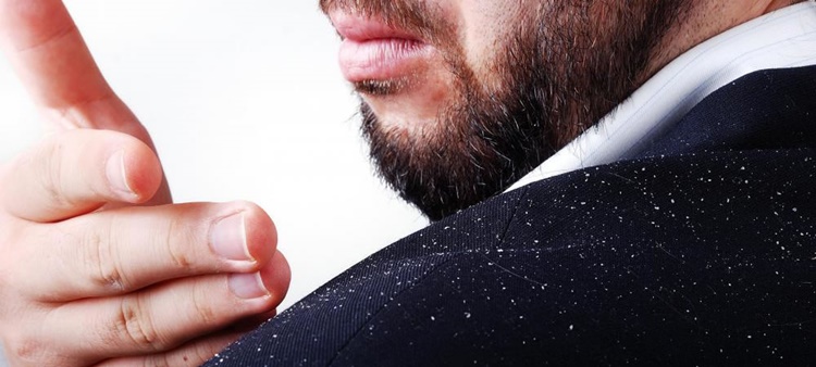 Dandruff Remedy