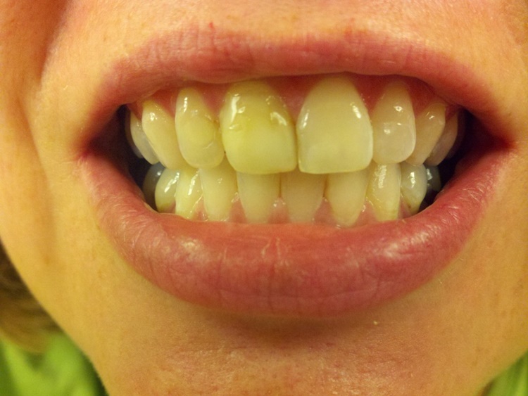Yellow Teeth Treatment