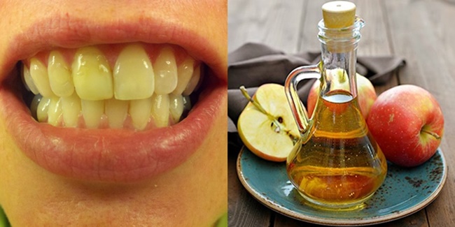 Will vinegar whiten your teeth