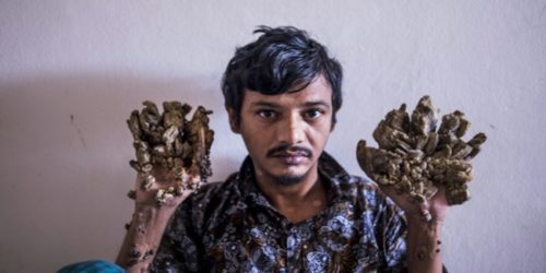 Bangladesh Tree man abul bajandar 3