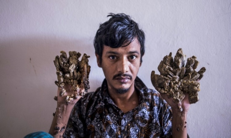 Bangladesh-Tree-man-abul-bajandar-3