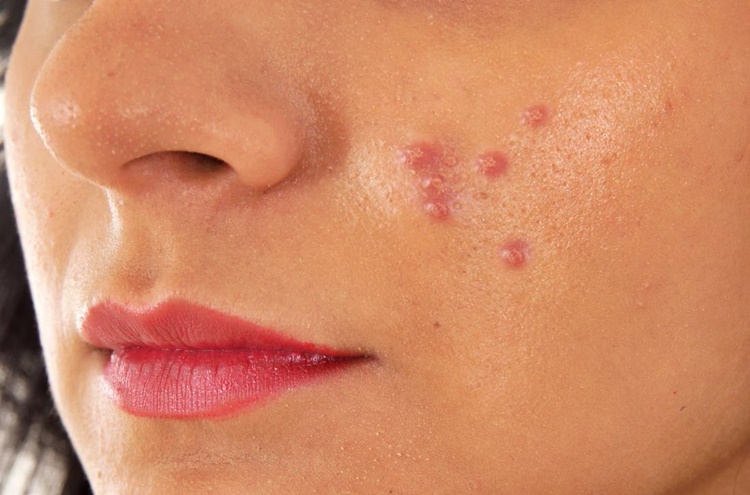 Acne Different Types Of This Face Condition And Its Treatment
