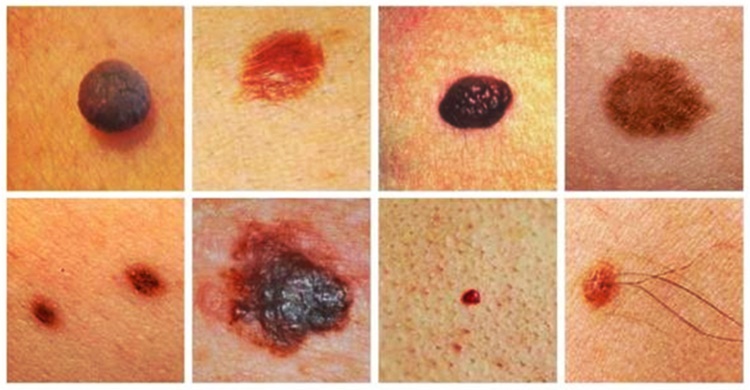 Skin Cancer