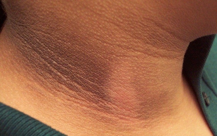 Dark Neck