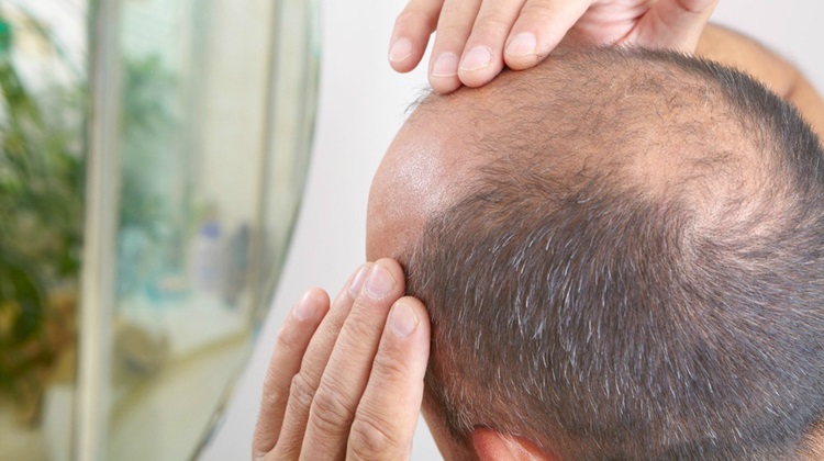 Hair Loss