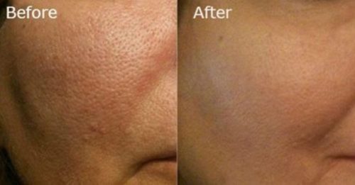 large pores home remedies