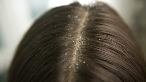 DANDRUFF