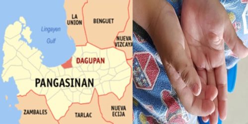 pangasinan dagupan HFMD 1
