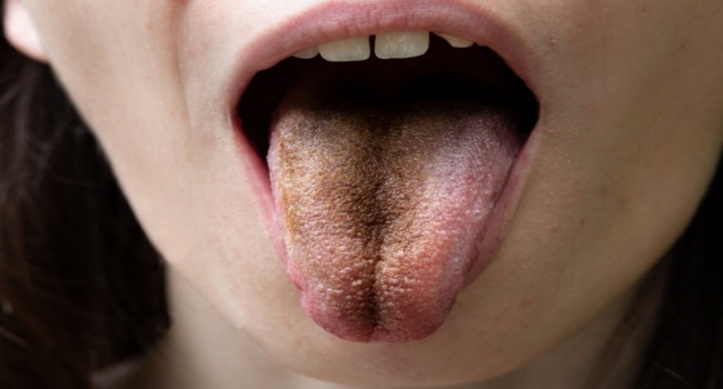 Tongue Health - What Does Your Tongue Say About Your Health?