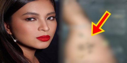 Angel Locsin bruises 1