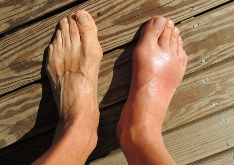 GOUT: Causes, Signs, Symptoms, Treatment & Prevention