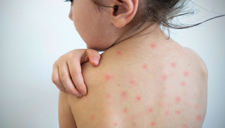 measles