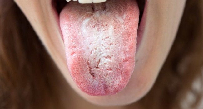 Tongue Health - What Does Your Tongue Say About Your Health?