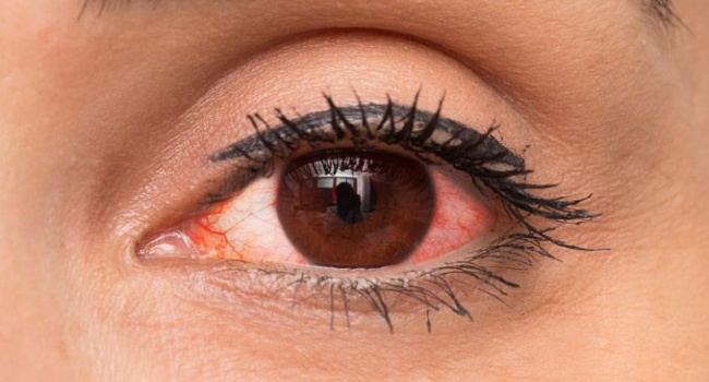 Red eyes