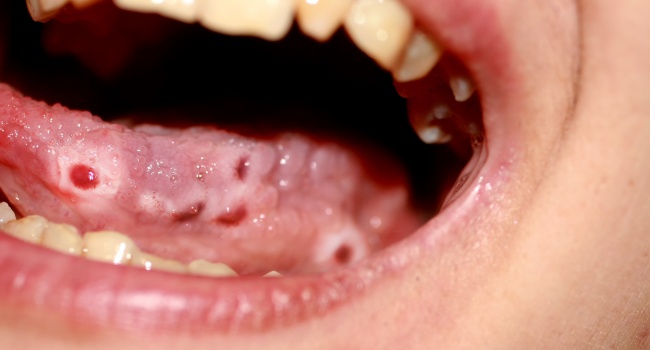 red-spots-on-back-of-throat-and-roof-of-mouth-causes-diagnosis