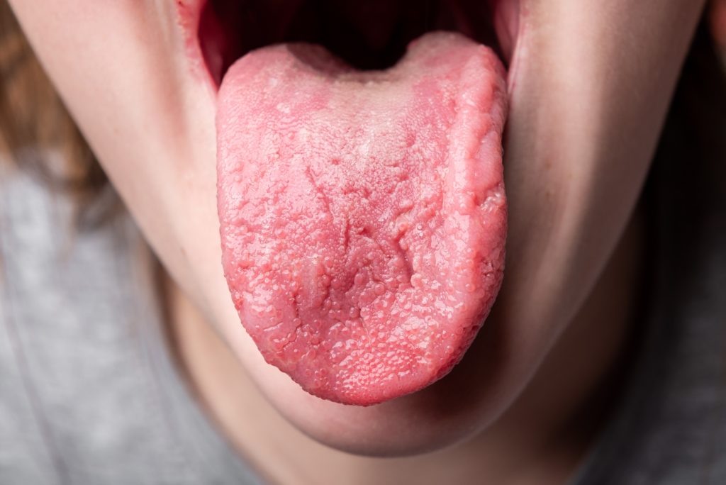 Tongue Health - What Does Your Tongue Say About Your Health?