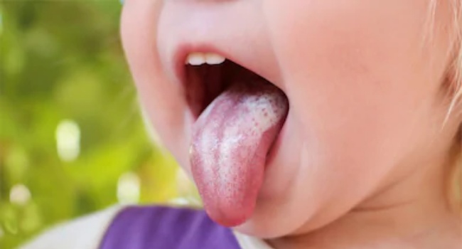 Tongue Health - What Does Your Tongue Say About Your Health?