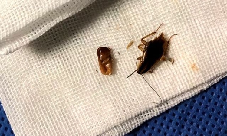 Family Of Cockroaches Found Crawling Inside Man's Ear