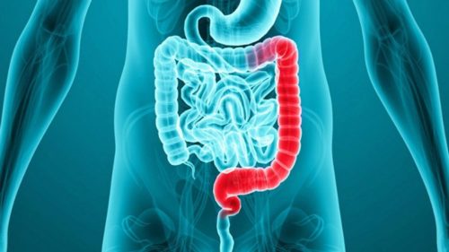 COLITIS: Symptoms, Causes, Risk Factors & Complications