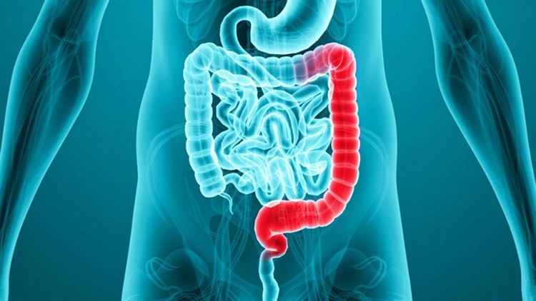 Cafe y colitis ulcerosa