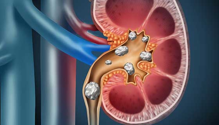 ivcd 10 for hx of kidney stones