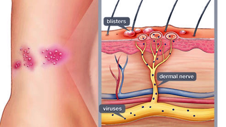 shingles symptoms