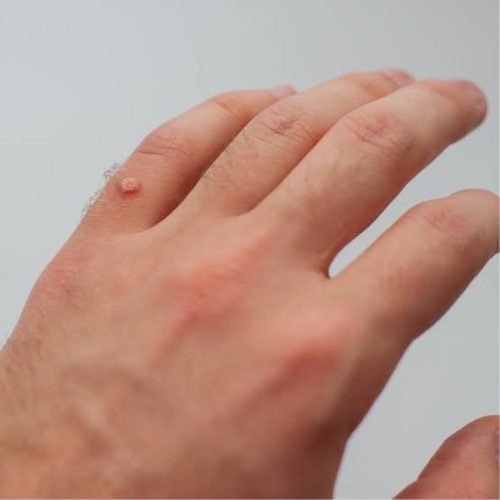 WARTS: Overview, Causes, Types, Treatment & Prevention