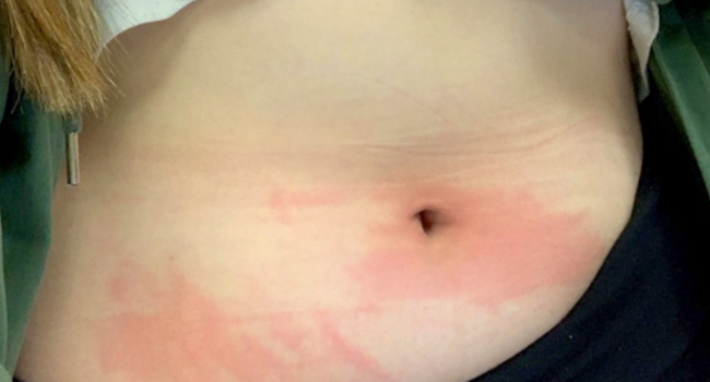 Student With Water Allergy Can Only Shower Twice A Month