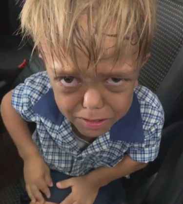 Boy with Dwarfism