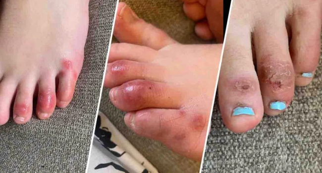 COVID TOES: Mystery Skin Disease Possible Link To COVID-19