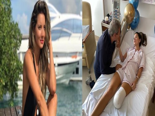 Miss Colombia Amputated