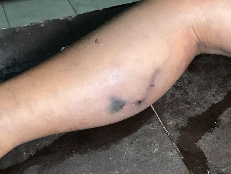 Snakebite
