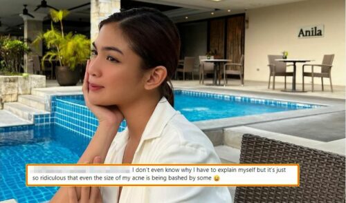 Heaven Peralejo Acne