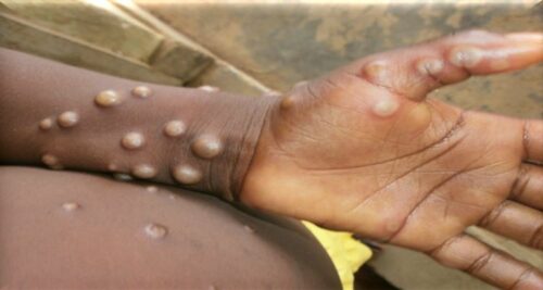 Monkeypox Philippines