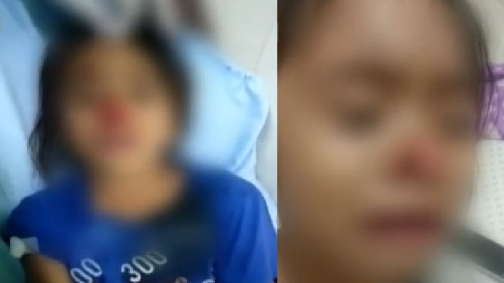 Girl Nose Bitten Dog