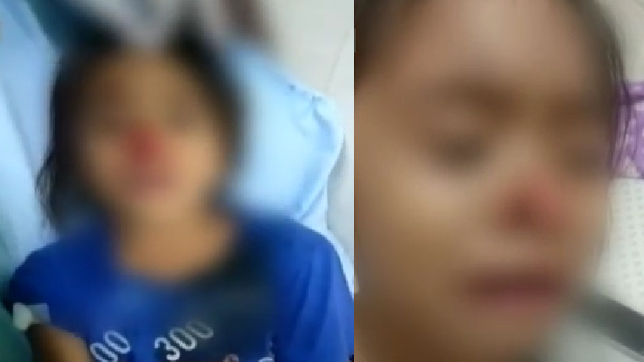 6-year-old Girl Loses Her Nose After Bitten By A Dog In Bataan