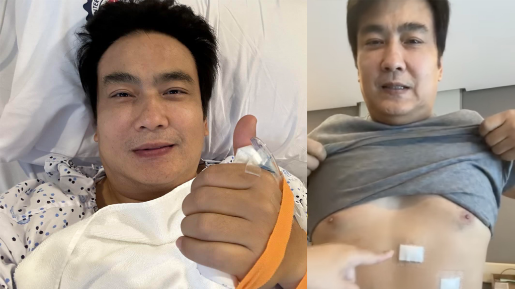 Revilla Gall Bladder Surgery