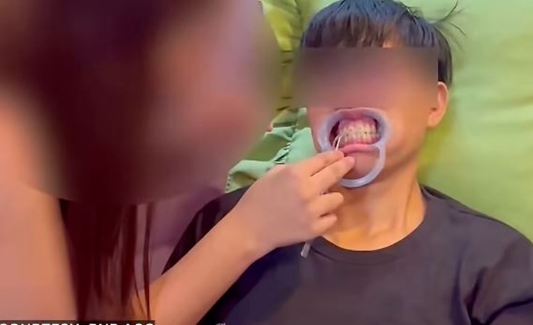 DIY Braces Service